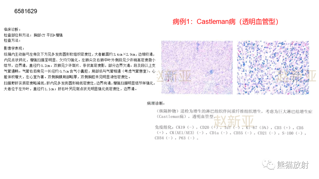 影像PPT - 【病例】纵隔Castleman病2例CT影像-17