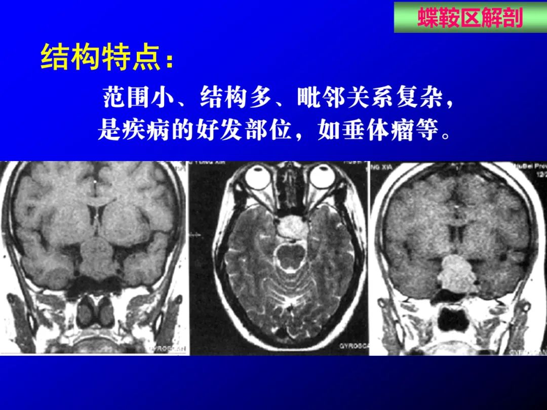 影像PPT - 【PPT】蝶鞍区断层解剖与影像对照-6
