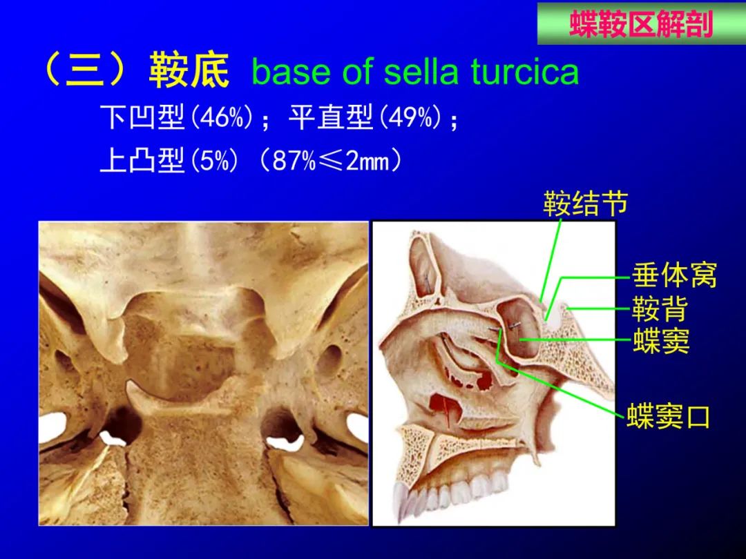 影像PPT - 【PPT】蝶鞍区断层解剖与影像对照-11