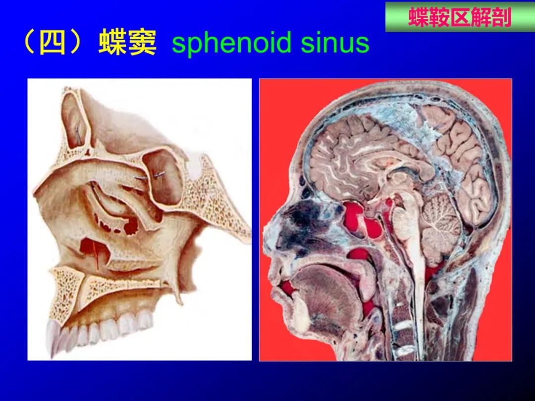 影像PPT - 【PPT】蝶鞍区断层解剖与影像对照-13