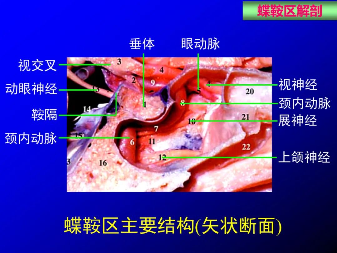 影像PPT - 【PPT】蝶鞍区断层解剖与影像对照-4