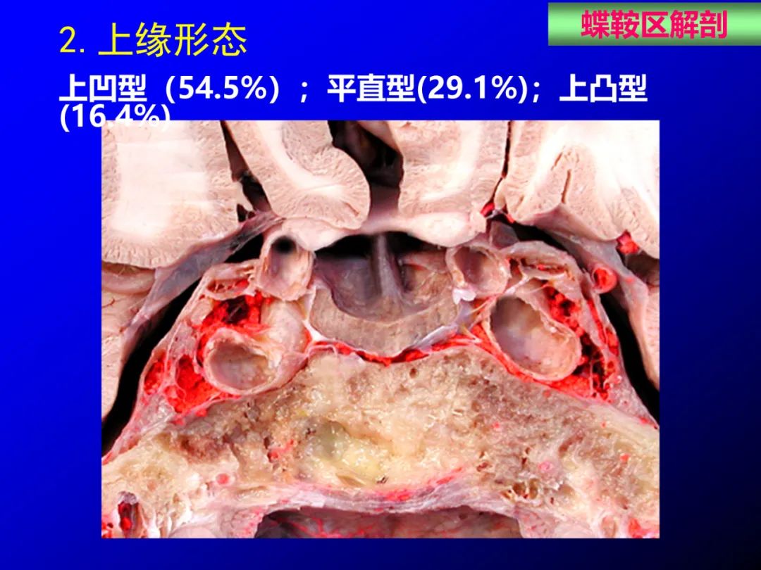 影像PPT - 【PPT】蝶鞍区断层解剖与影像对照-16