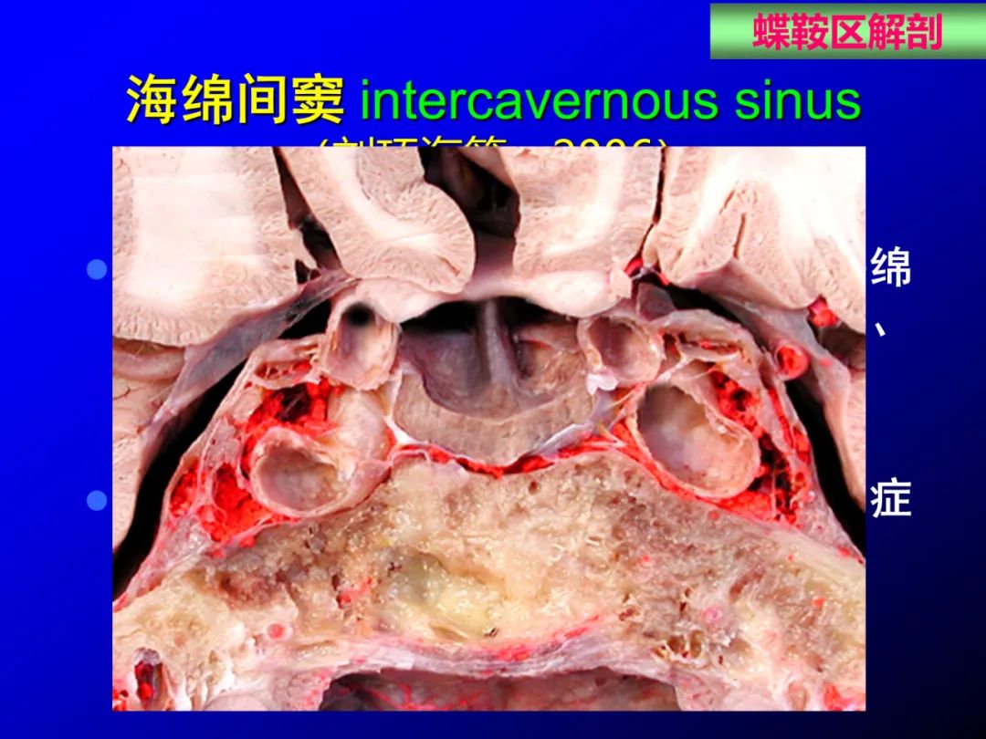 影像PPT - 【PPT】蝶鞍区断层解剖与影像对照-23