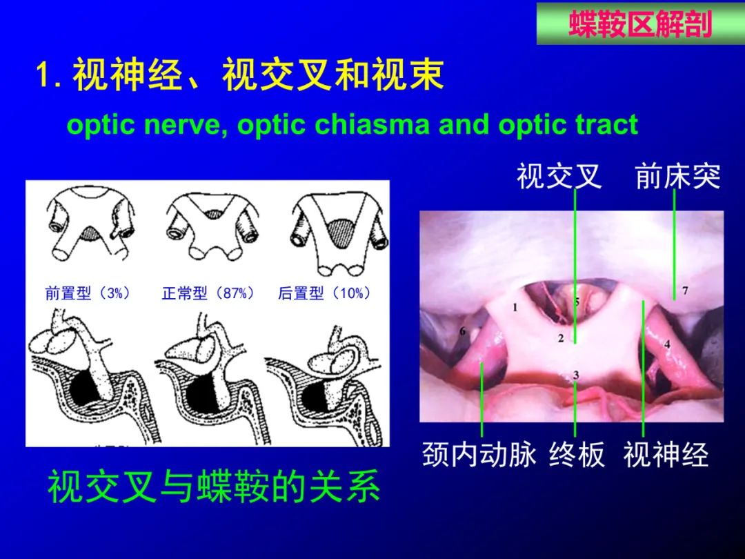 影像PPT - 【PPT】蝶鞍区断层解剖与影像对照-32