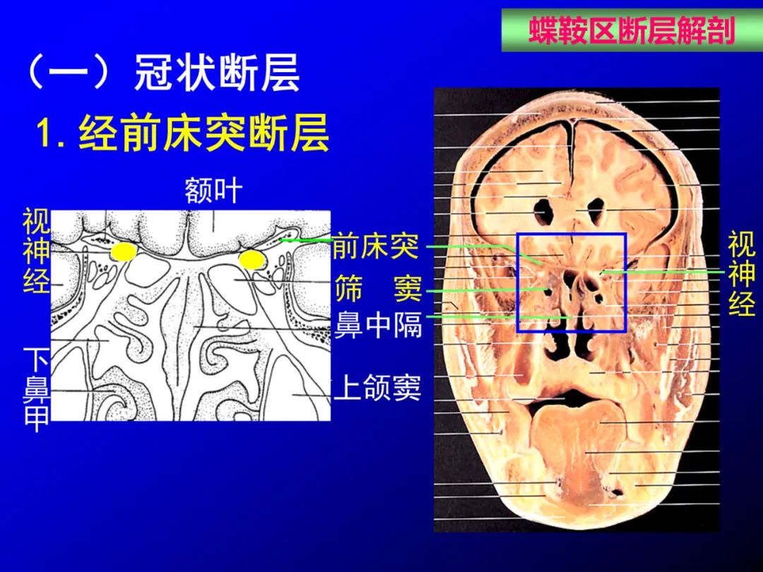 影像PPT - 【PPT】蝶鞍区断层解剖与影像对照-39