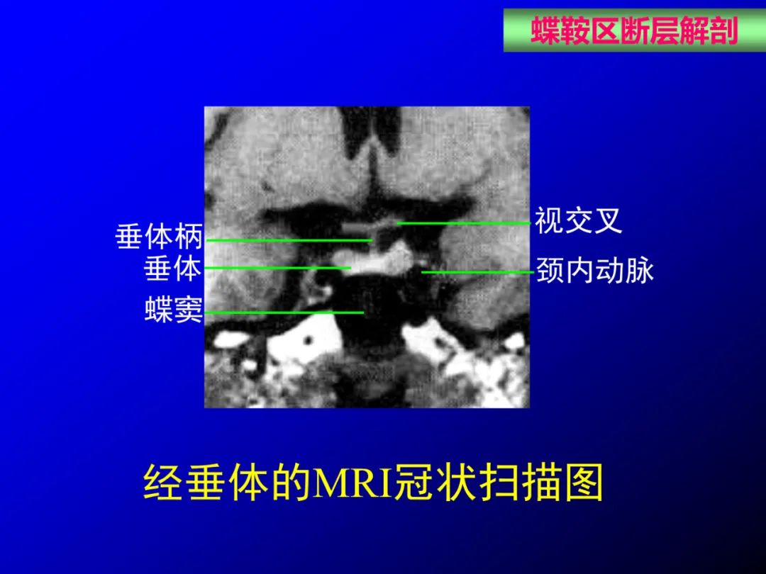 影像PPT - 【PPT】蝶鞍区断层解剖与影像对照-42