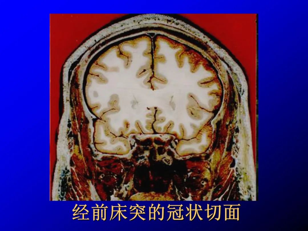 影像PPT - 【PPT】蝶鞍区断层解剖与影像对照-40