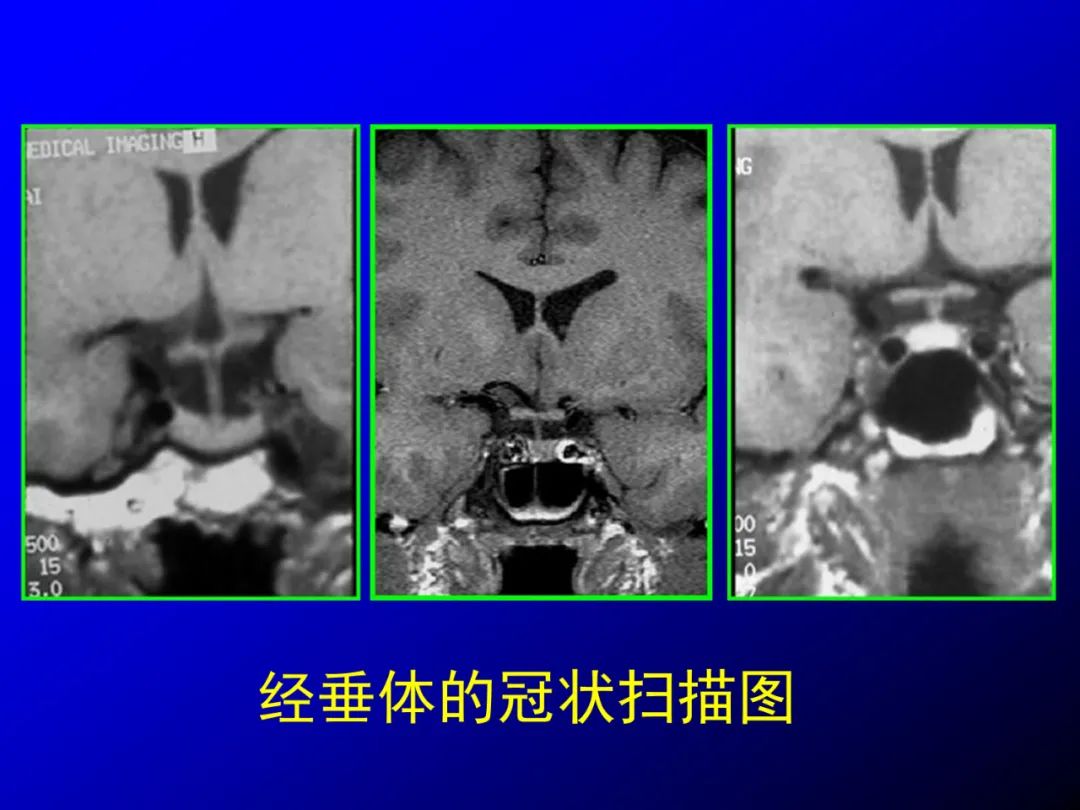 影像PPT - 【PPT】蝶鞍区断层解剖与影像对照-43