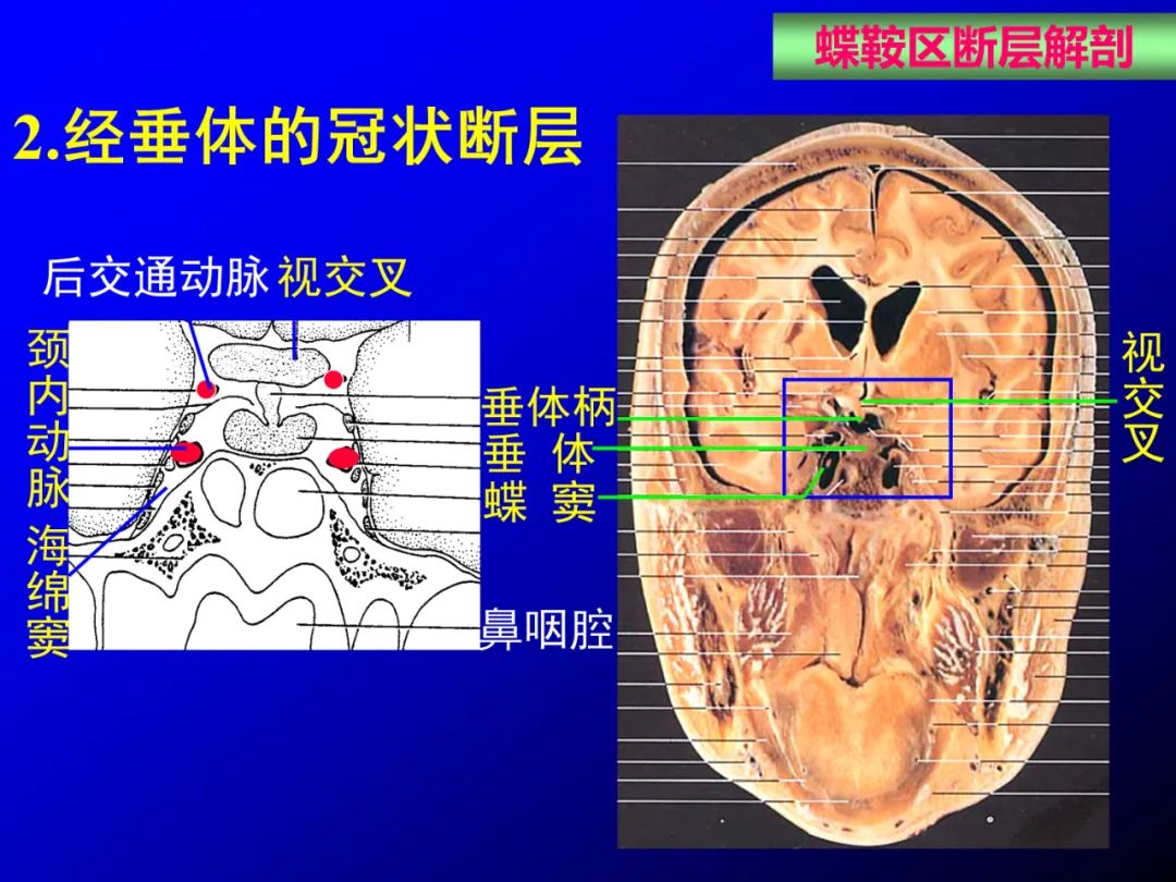 影像PPT - 【PPT】蝶鞍区断层解剖与影像对照-41