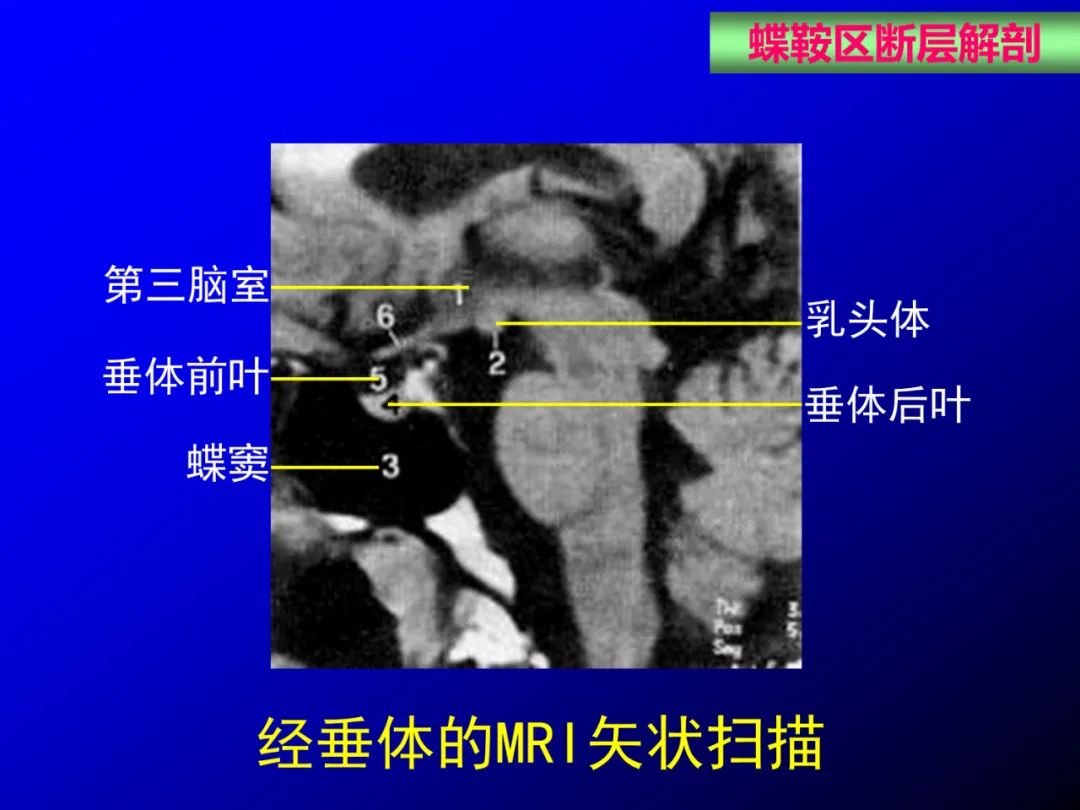 影像PPT - 【PPT】蝶鞍区断层解剖与影像对照-47