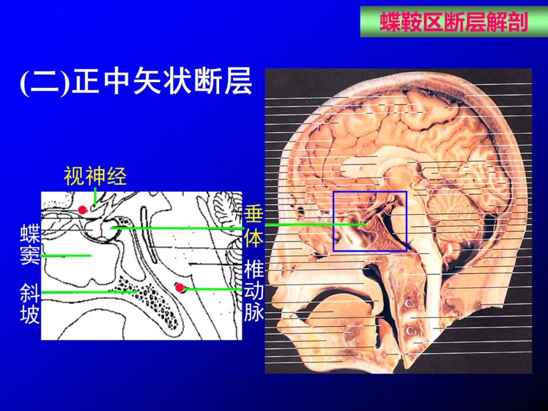 影像PPT - 【PPT】蝶鞍区断层解剖与影像对照-45