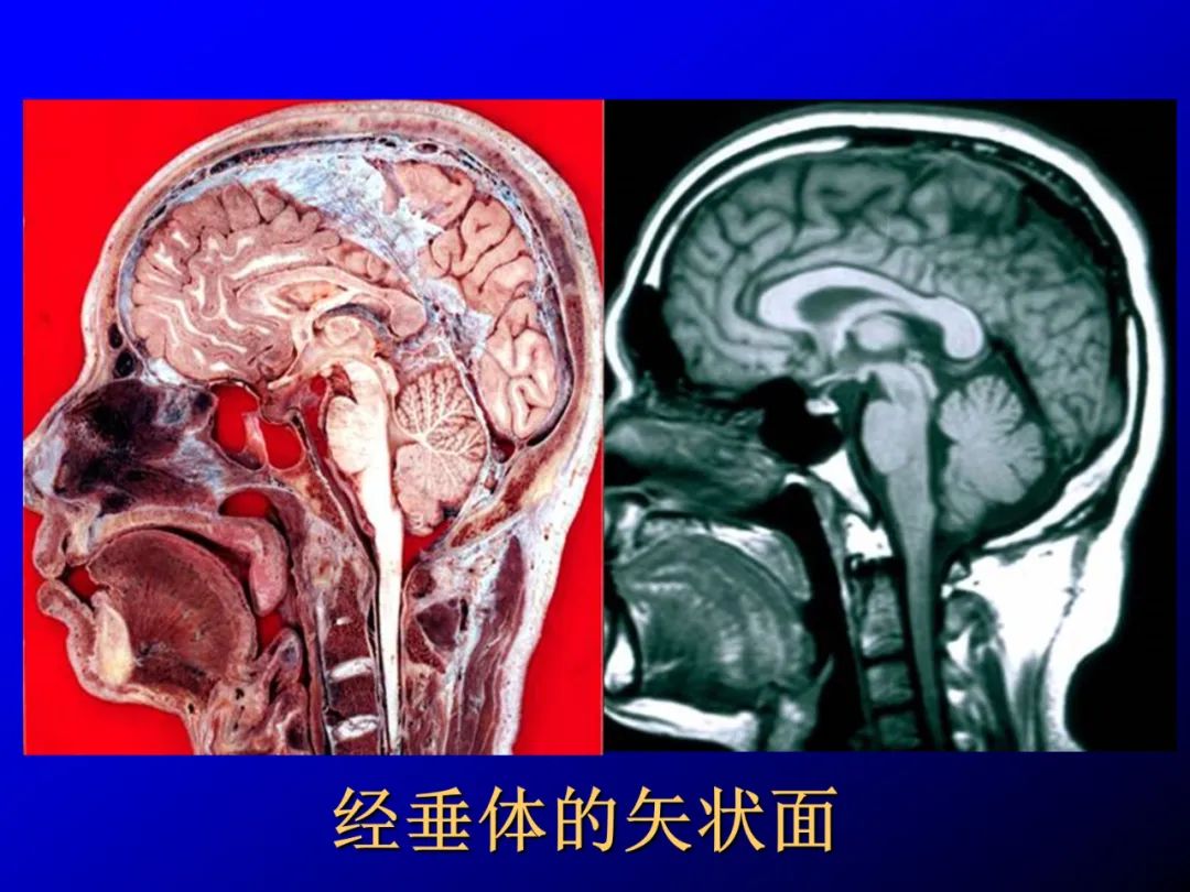 影像PPT - 【PPT】蝶鞍区断层解剖与影像对照-46