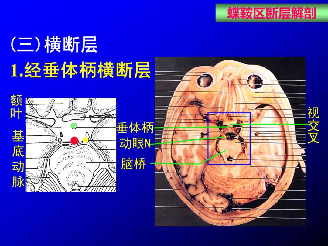 影像PPT - 【PPT】蝶鞍区断层解剖与影像对照-48