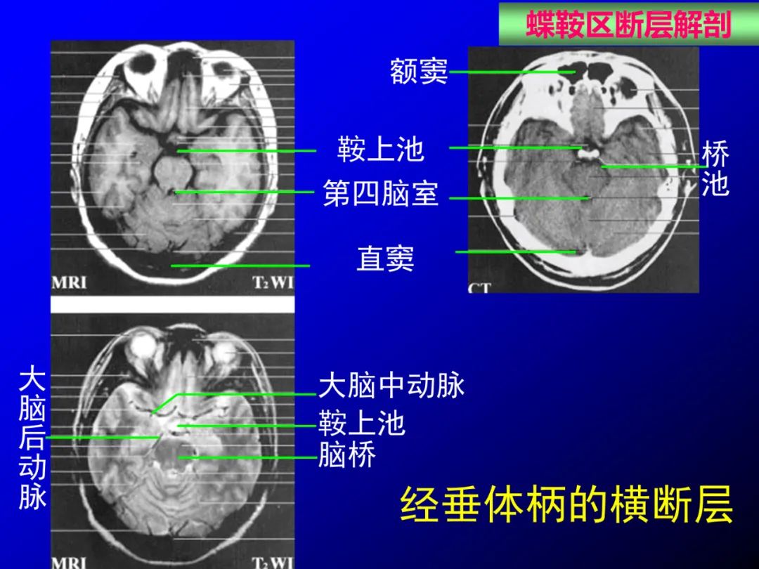 影像PPT - 【PPT】蝶鞍区断层解剖与影像对照-50