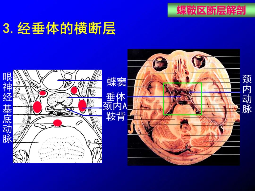 影像PPT - 【PPT】蝶鞍区断层解剖与影像对照-53