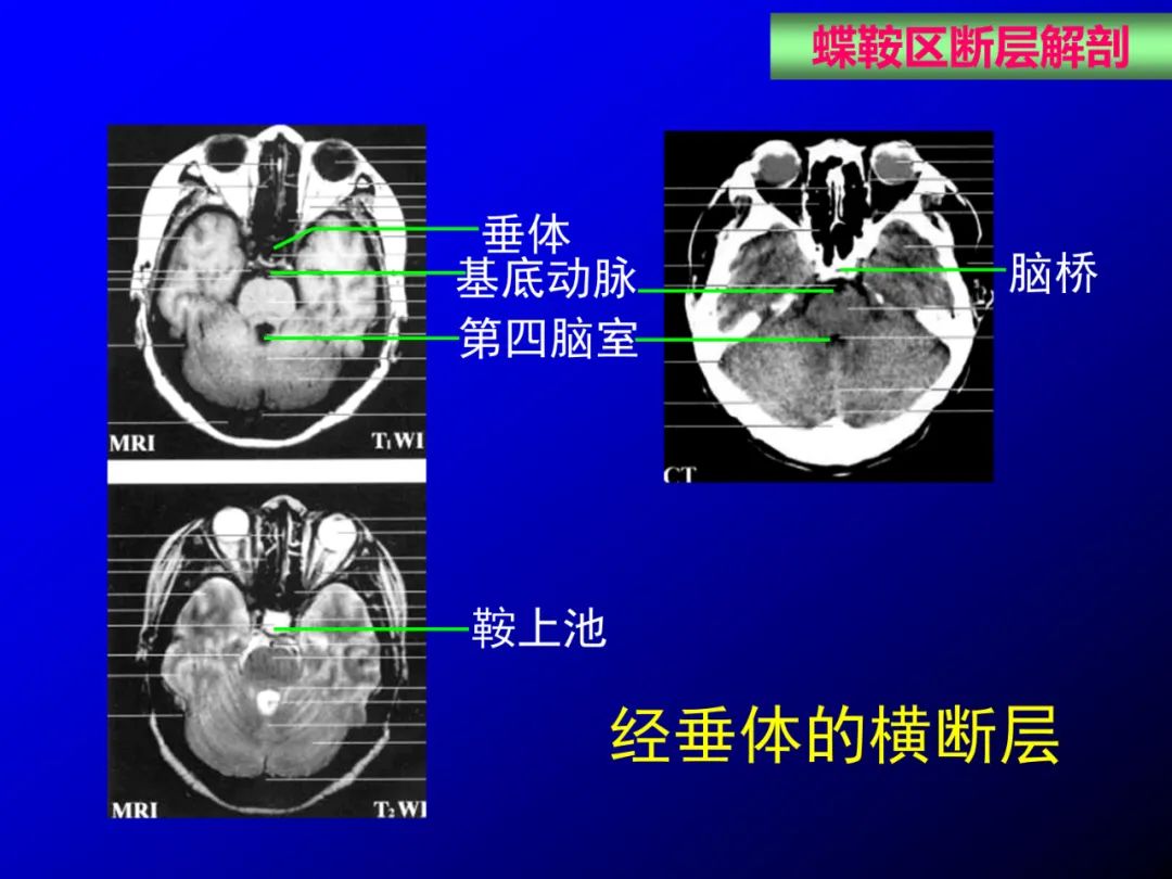 影像PPT - 【PPT】蝶鞍区断层解剖与影像对照-54