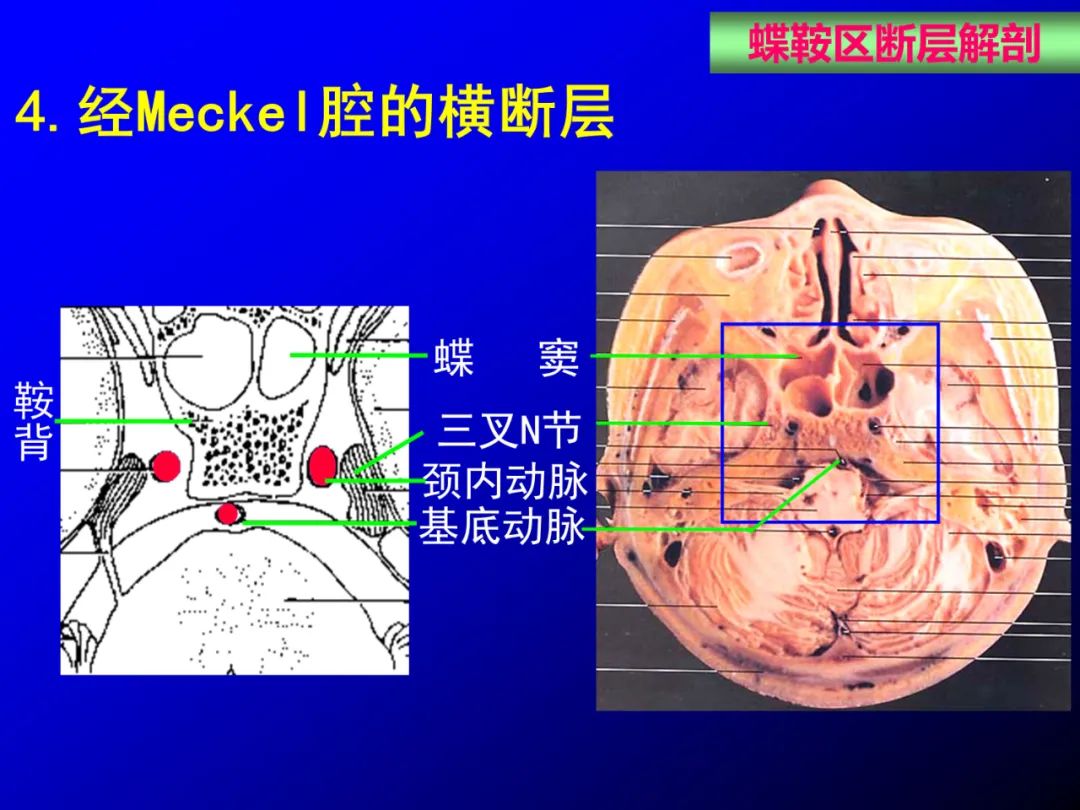 影像PPT - 【PPT】蝶鞍区断层解剖与影像对照-55