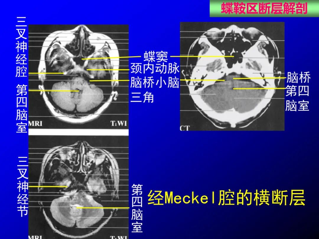 影像PPT - 【PPT】蝶鞍区断层解剖与影像对照-56