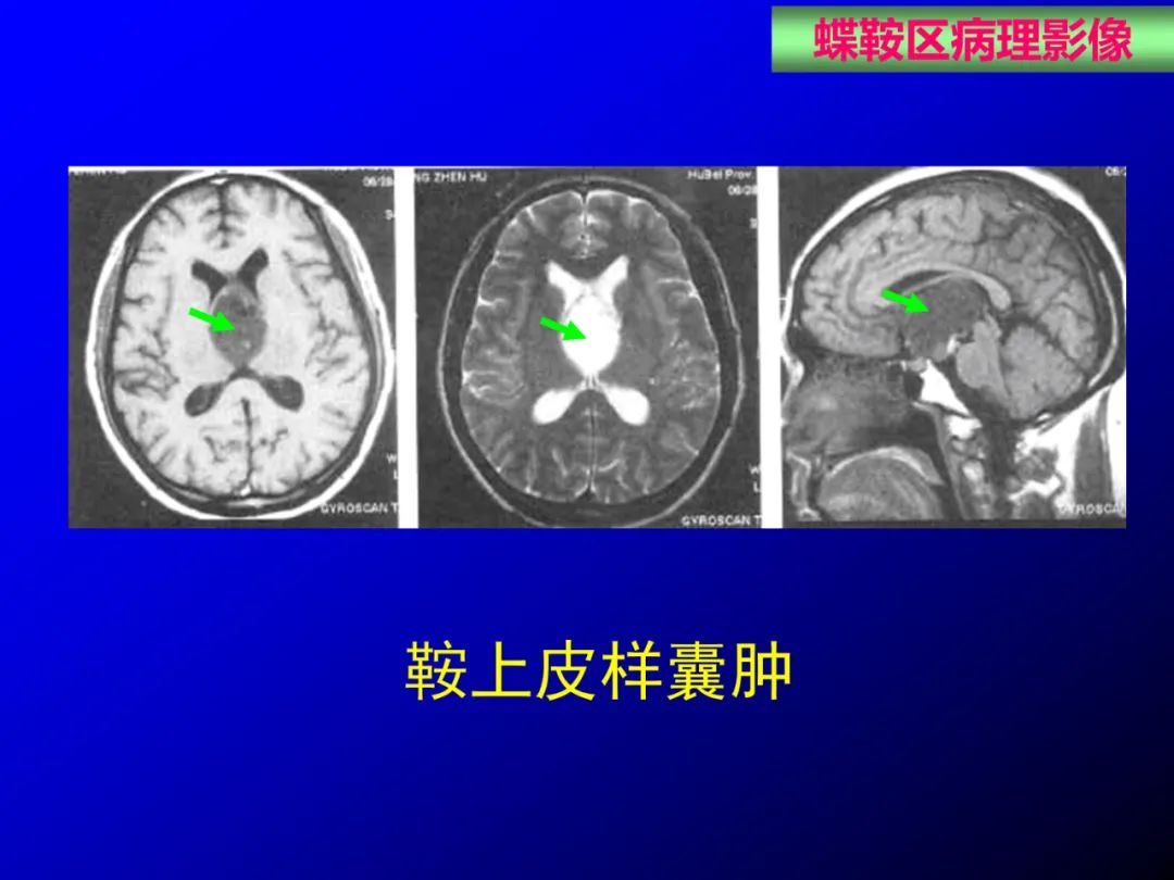 影像PPT - 【PPT】蝶鞍区断层解剖与影像对照-62