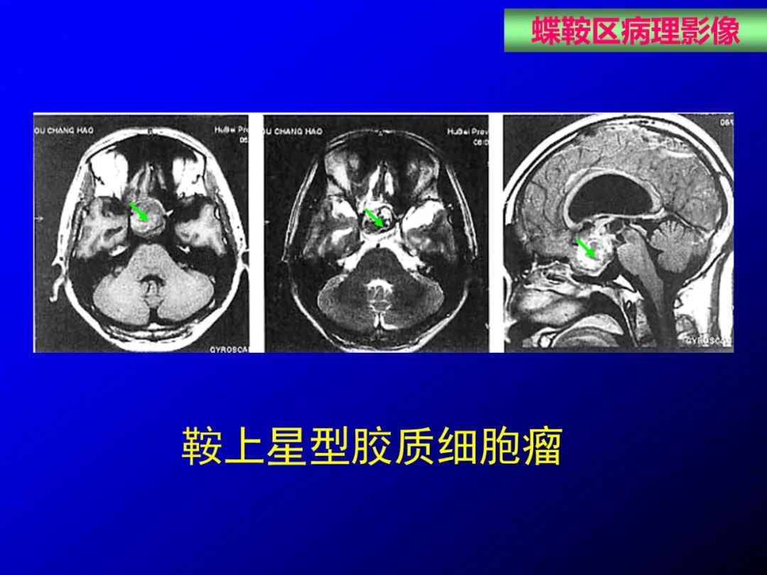 影像PPT - 【PPT】蝶鞍区断层解剖与影像对照-59