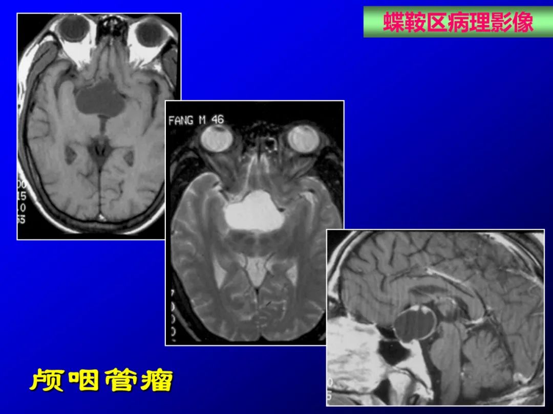 影像PPT - 【PPT】蝶鞍区断层解剖与影像对照-60