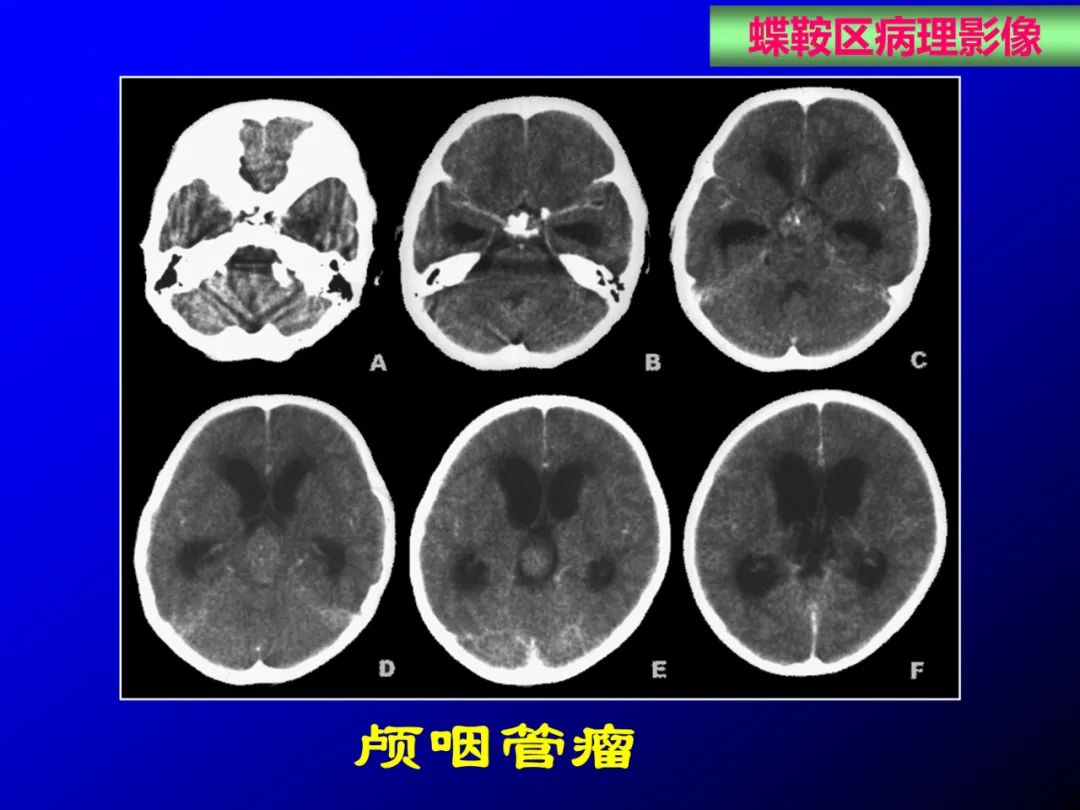 影像PPT - 【PPT】蝶鞍区断层解剖与影像对照-61