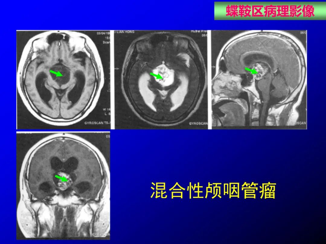 影像PPT - 【PPT】蝶鞍区断层解剖与影像对照-63