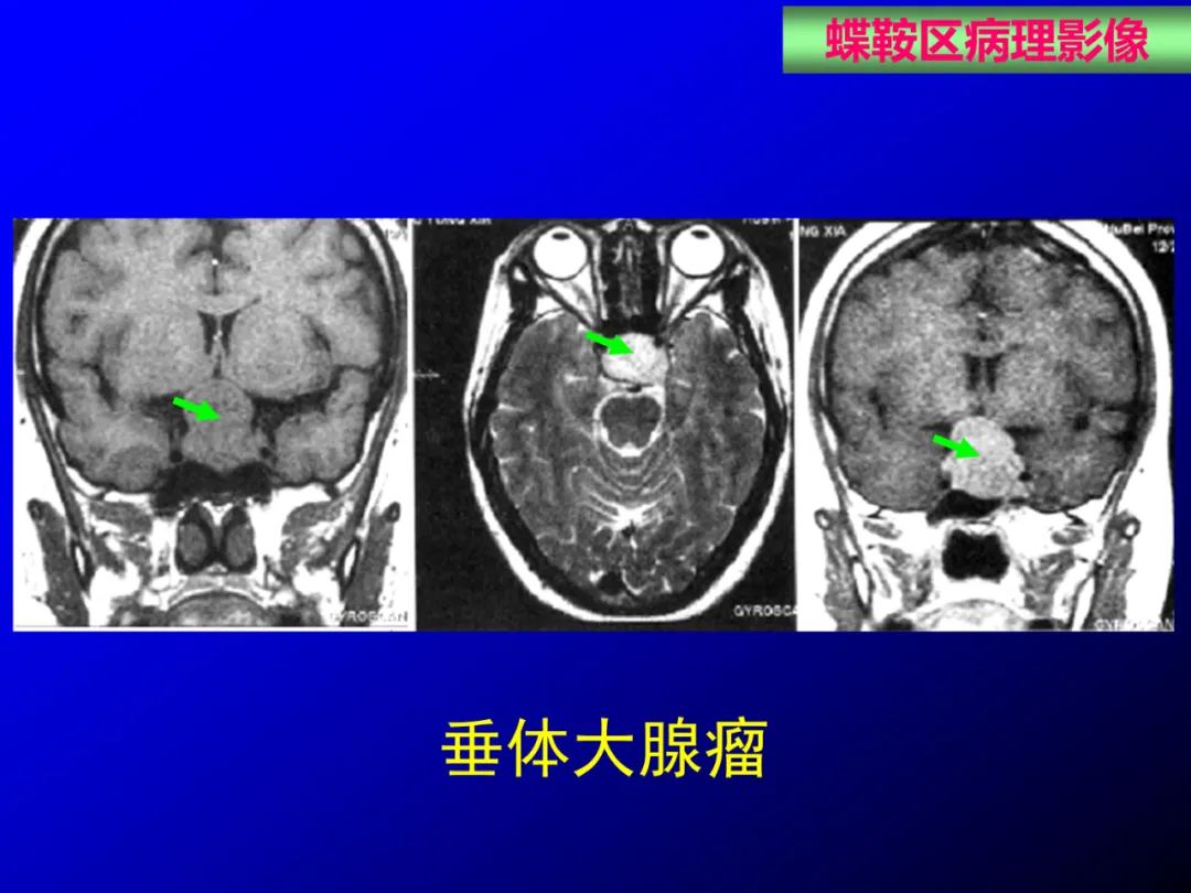 影像PPT - 【PPT】蝶鞍区断层解剖与影像对照-64