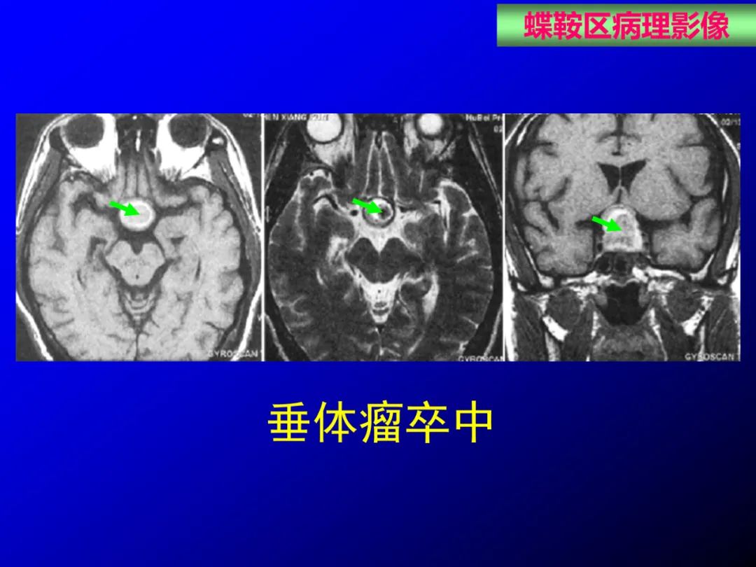 影像PPT - 【PPT】蝶鞍区断层解剖与影像对照-65