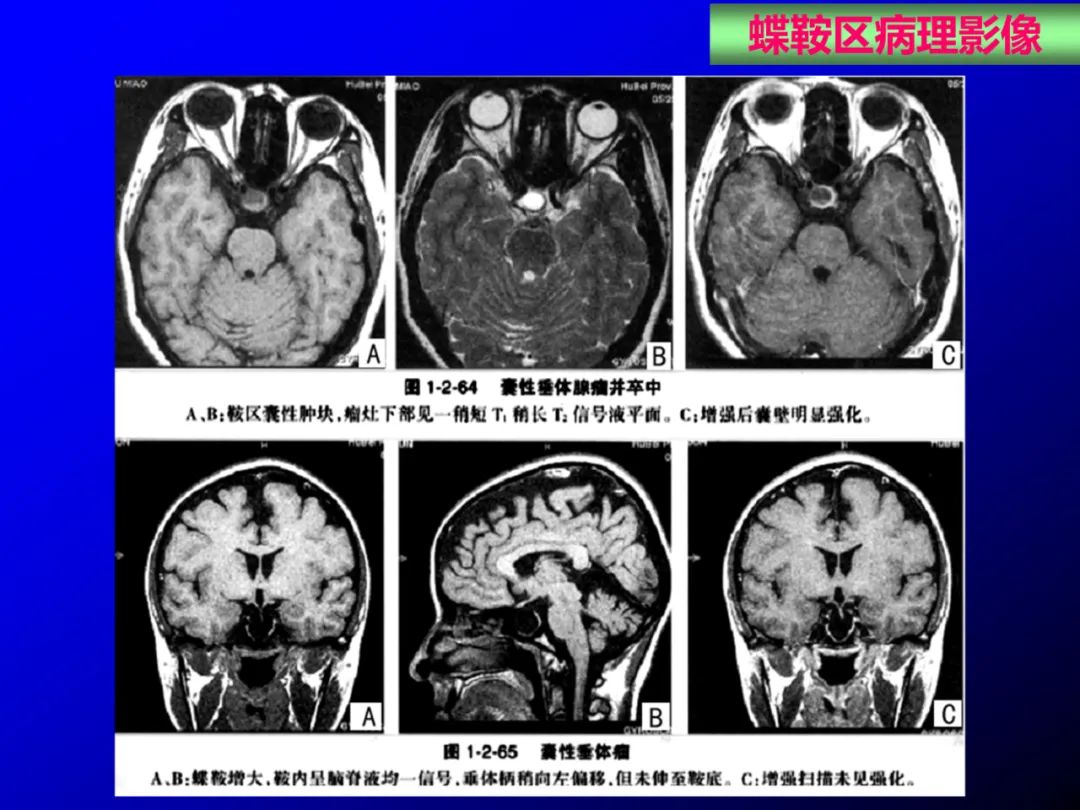 影像PPT - 【PPT】蝶鞍区断层解剖与影像对照-66