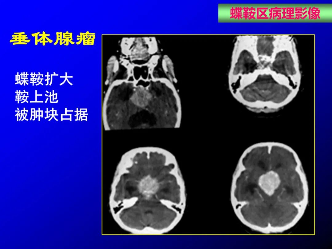 影像PPT - 【PPT】蝶鞍区断层解剖与影像对照-67