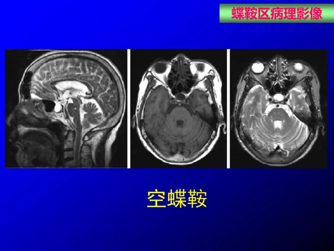 影像PPT - 【PPT】蝶鞍区断层解剖与影像对照-68