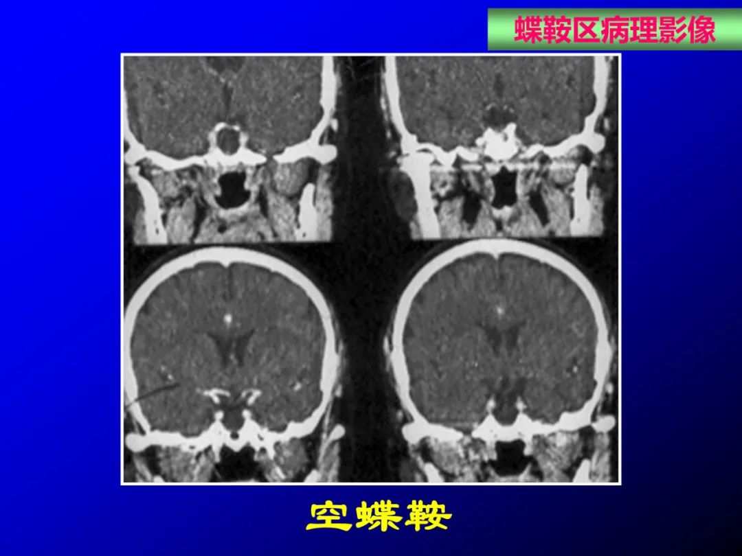 影像PPT - 【PPT】蝶鞍区断层解剖与影像对照-70
