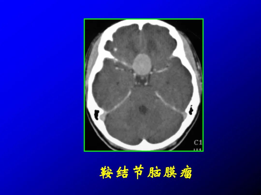 影像PPT - 【PPT】蝶鞍区断层解剖与影像对照-72