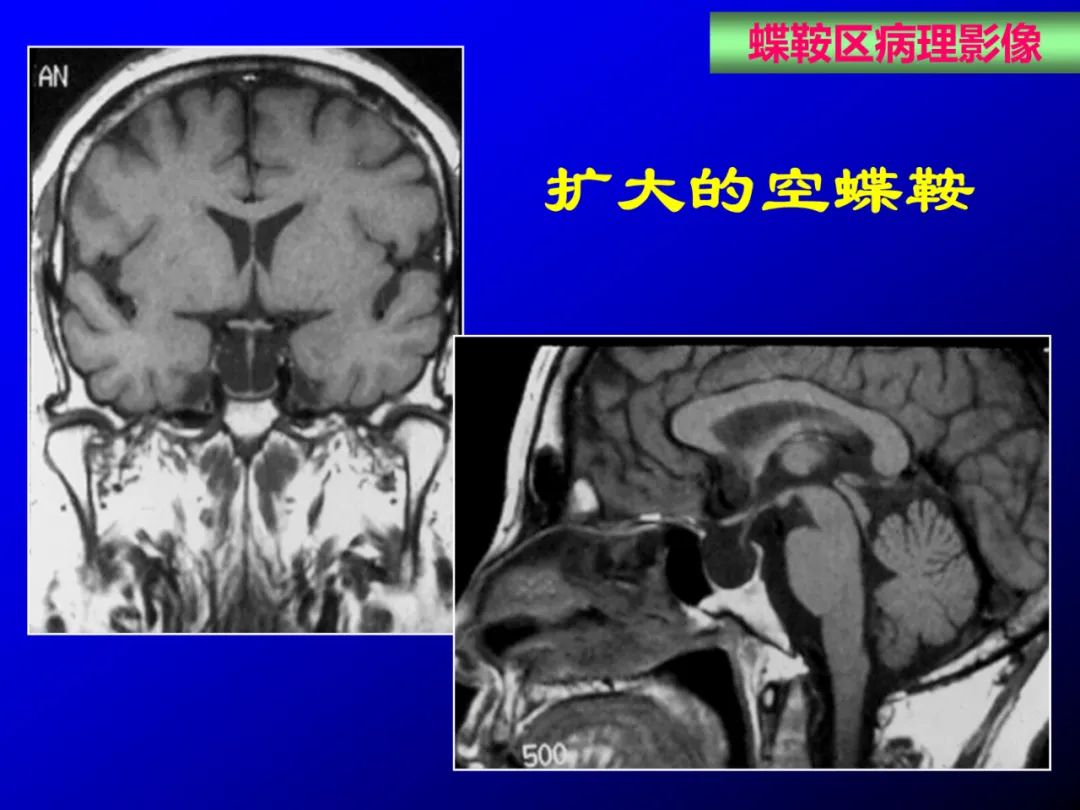 影像PPT - 【PPT】蝶鞍区断层解剖与影像对照-69