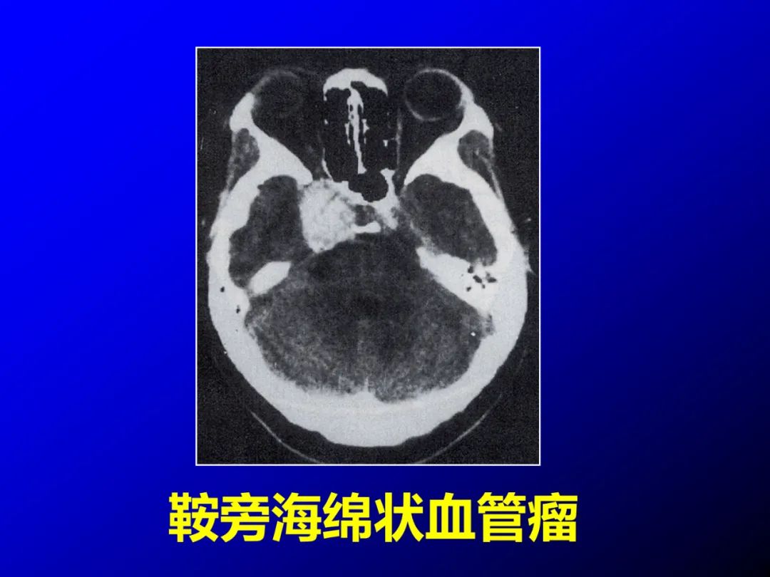 影像PPT - 【PPT】蝶鞍区断层解剖与影像对照-75