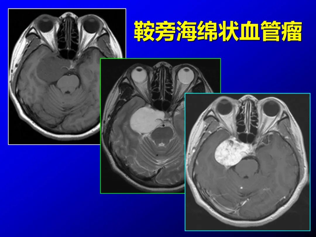 影像PPT - 【PPT】蝶鞍区断层解剖与影像对照-74