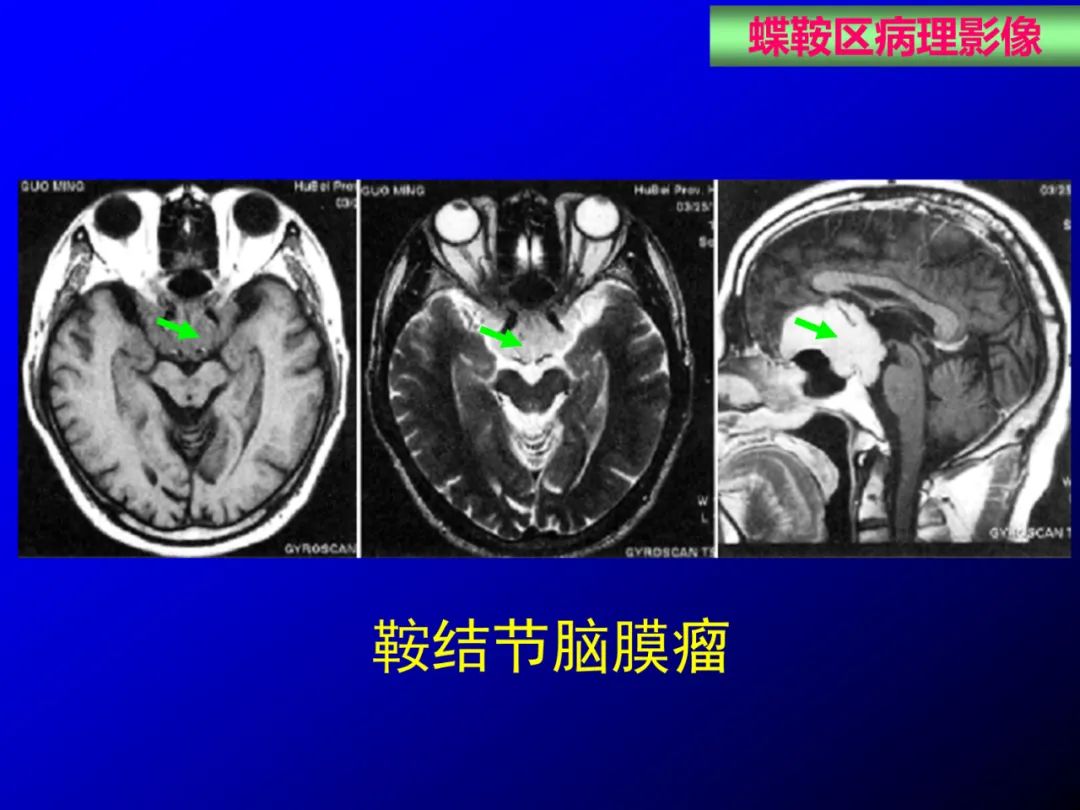 影像PPT - 【PPT】蝶鞍区断层解剖与影像对照-73
