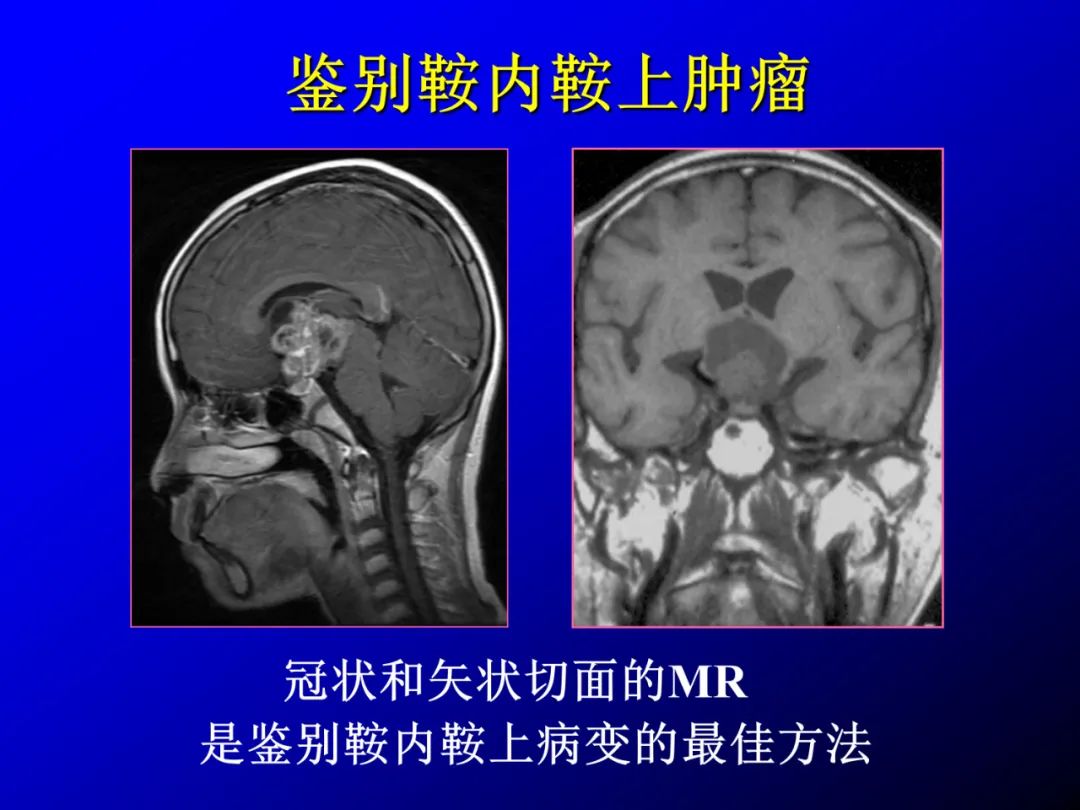 影像PPT - 【PPT】蝶鞍区断层解剖与影像对照-76