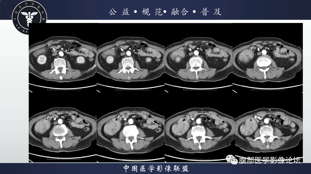影像PPT - 【病例】结肠癌1例CT影像鉴别诊断思路-4