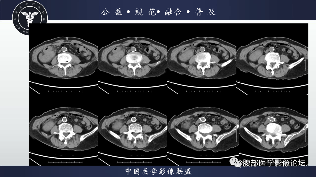 影像PPT - 【病例】结肠癌1例CT影像鉴别诊断思路-3