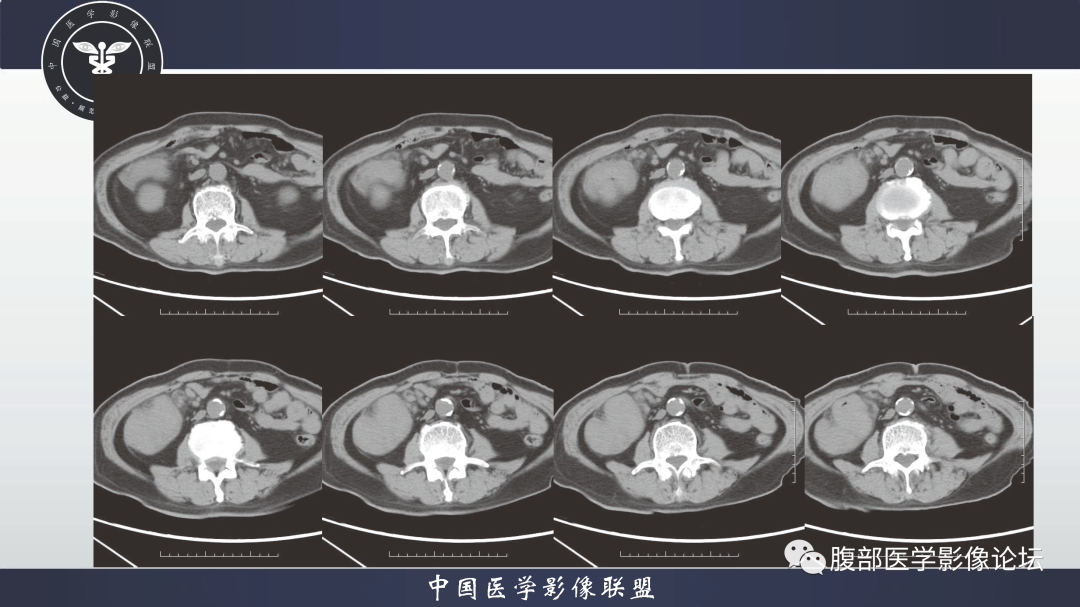 影像PPT - 【病例】结肠癌1例CT影像鉴别诊断思路-2
