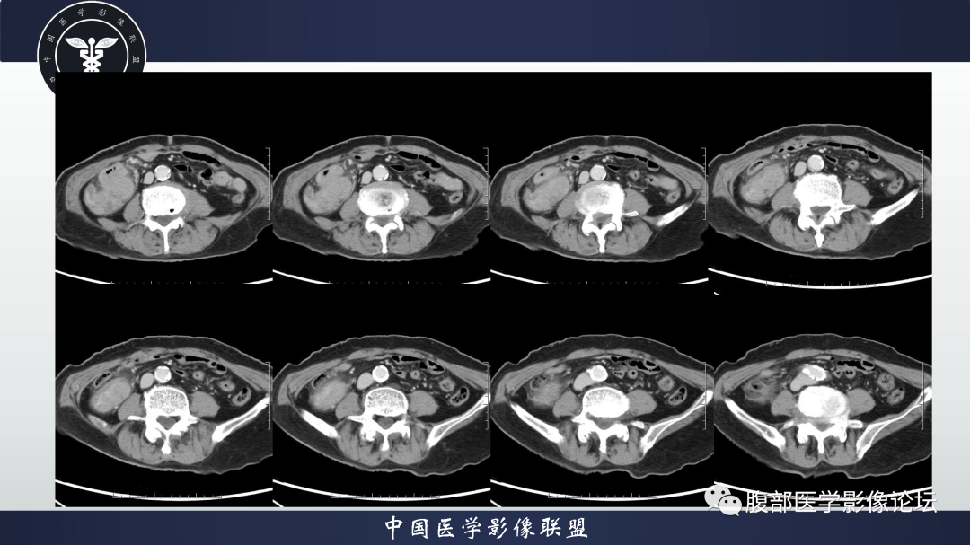 影像PPT - 【病例】结肠癌1例CT影像鉴别诊断思路-7