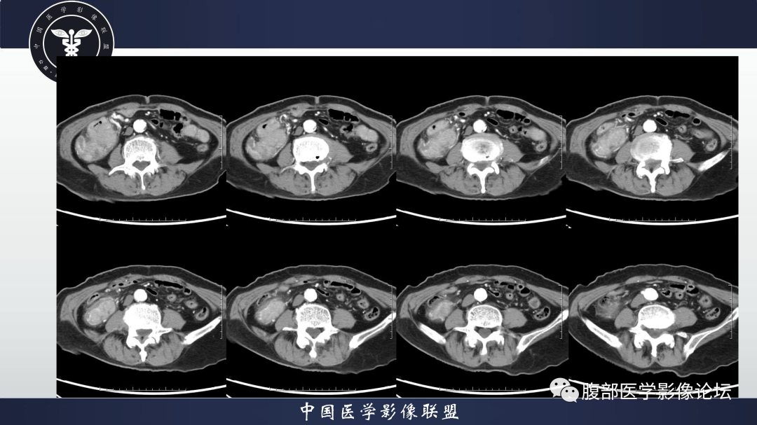 影像PPT - 【病例】结肠癌1例CT影像鉴别诊断思路-5