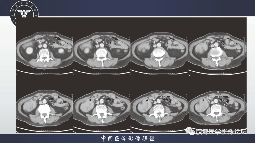 影像PPT - 【病例】结肠癌1例CT影像鉴别诊断思路-6