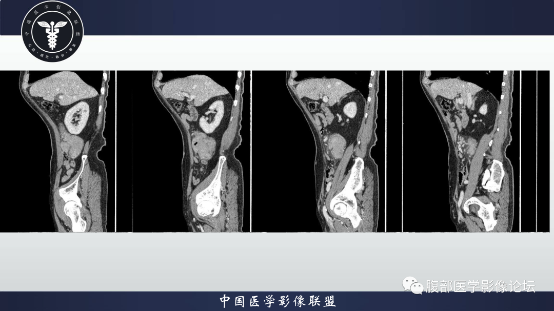 影像PPT - 【病例】结肠癌1例CT影像鉴别诊断思路-11