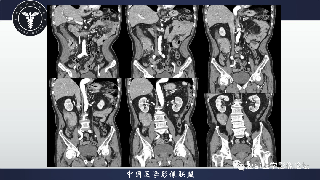 影像PPT - 【病例】结肠癌1例CT影像鉴别诊断思路-9