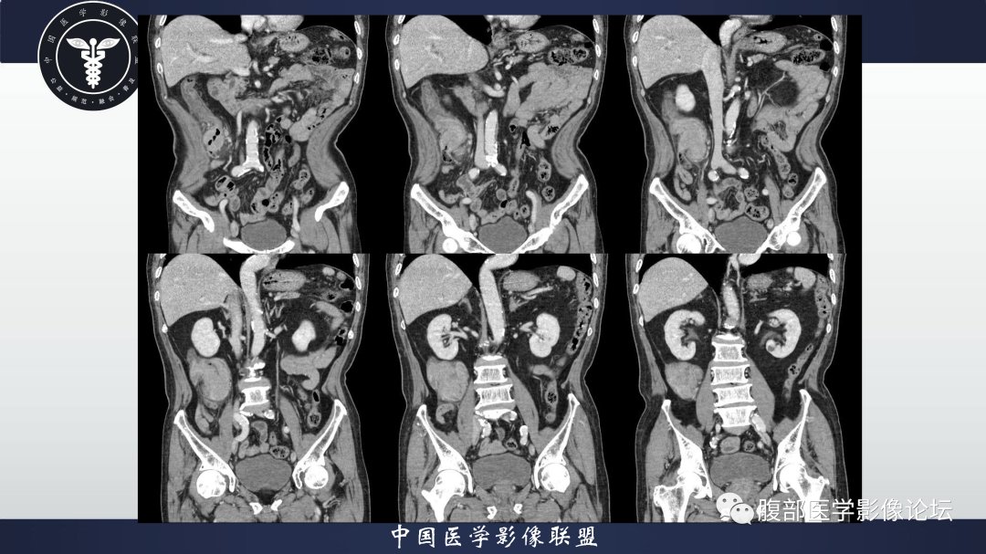 影像PPT - 【病例】结肠癌1例CT影像鉴别诊断思路-10