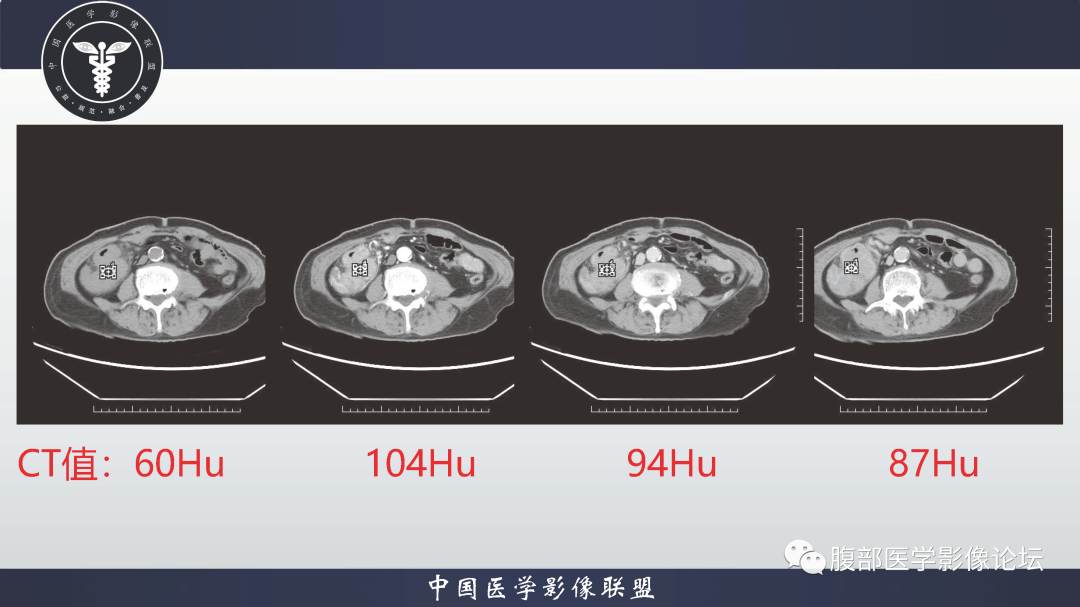 影像PPT - 【病例】结肠癌1例CT影像鉴别诊断思路-12