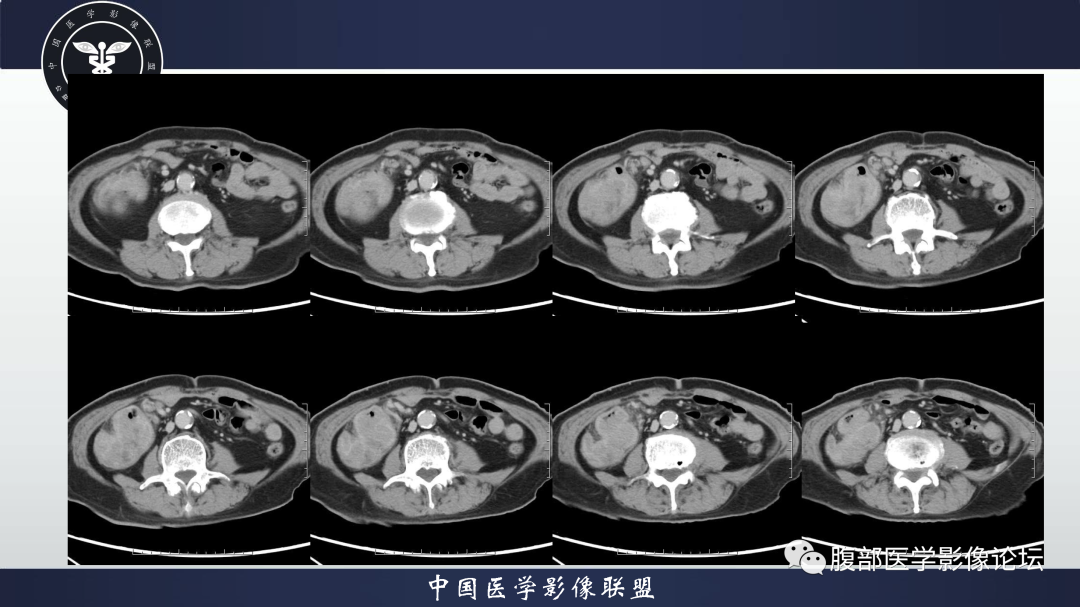 影像PPT - 【病例】结肠癌1例CT影像鉴别诊断思路-8